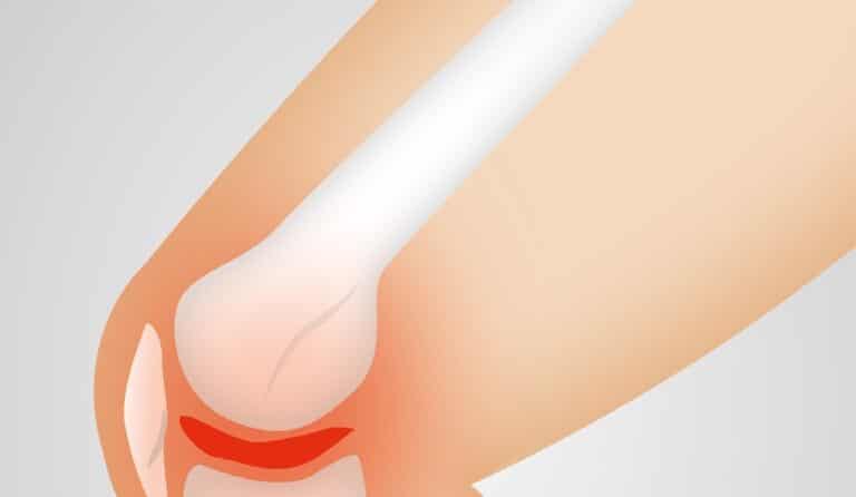 Arthrosis Nefrocenter