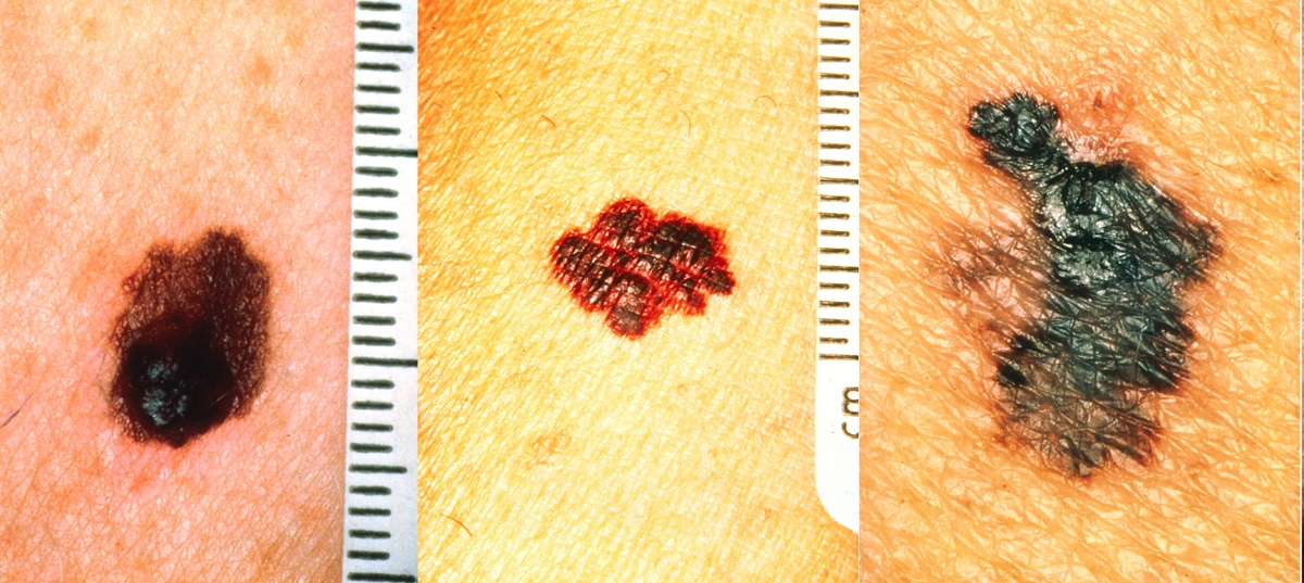 melanoma