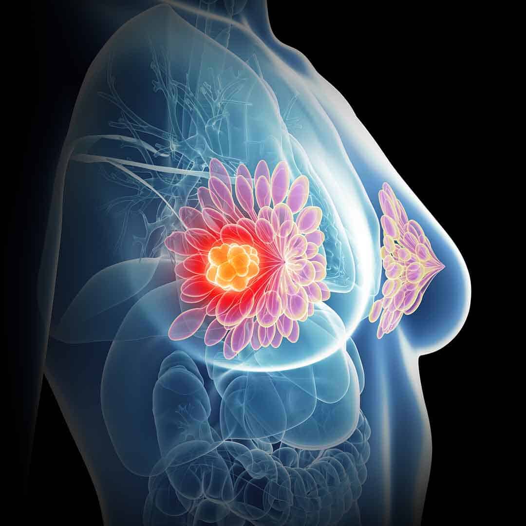 il tumore al seno