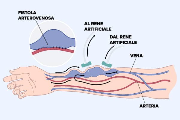 La cura della fistola artero-venosa in dialisi